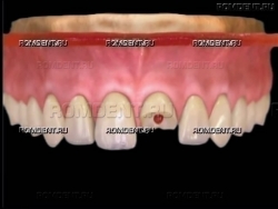 ROMDENT | Разрушение зуба