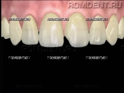 ROMDENT | Разрушение зуба