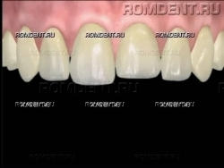 ROMDENT | Разрушение зуба