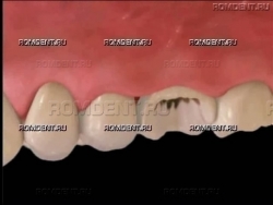 ROMDENT | Разрушение зуба