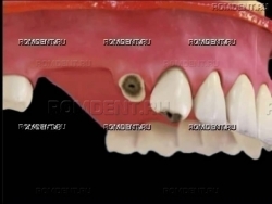 ROMDENT | Разрушение зуба