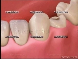 ROMDENT | Разрушение зуба