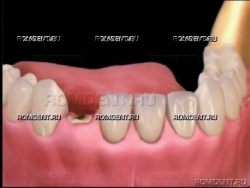 ROMDENT | Разрушение зуба