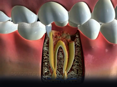 ROMDENT | Абсцесс зуба — острое гнойное воспаление