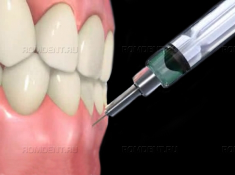 ROMDENT | Анестезия в стоматологии - препараты и виды