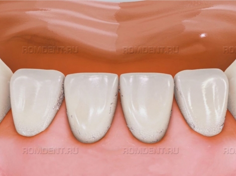 ROMDENT | Деминерализация зубов