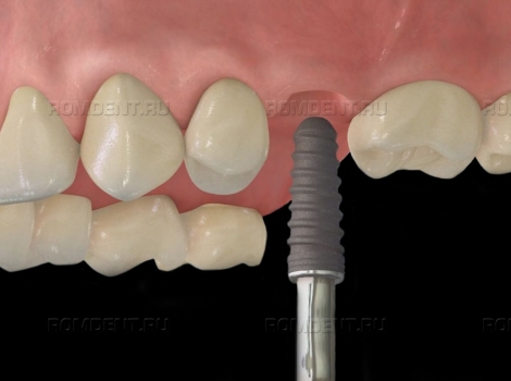 ROMDENT | Дентальная имплантация зубов