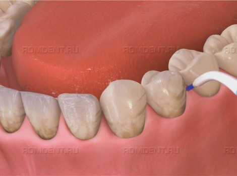 ROMDENT | Что такое ирригатор для зубов и зачем он нужен?