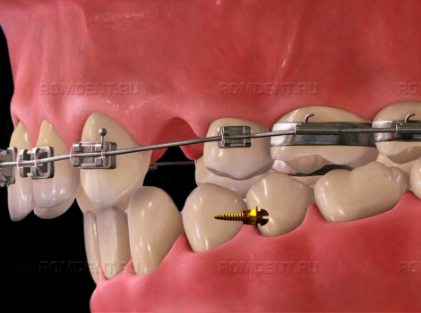 ROMDENT | Ортодонтический мини-имплант: виды, показания и преимущества