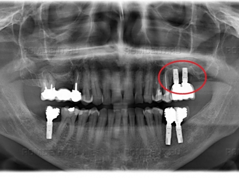 ROMDENT | Периимплантит