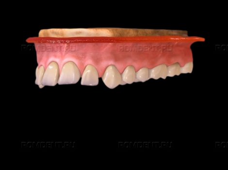 ROMDENT | Щели между зубами — диастема и тремы