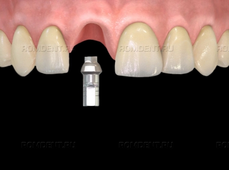 ROMDENT | Абатмент для имплантов: что это такое?