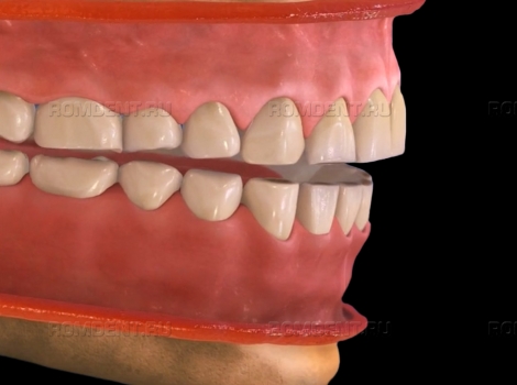 ROMDENT | Бруксизм — непроизвольный скрежет зубами