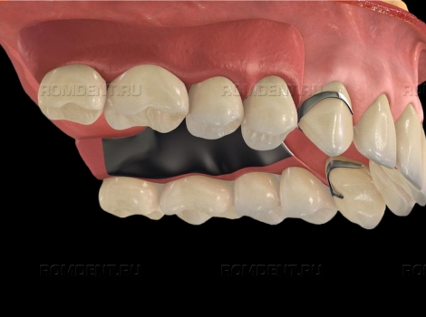 ROMDENT | Бюгельное протезирование зубов