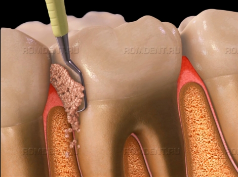 ROMDENT | Зубной камень – симптомы и лечение
