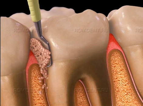 ROMDENT | Цена на лечение пародонтита: качество и доступность