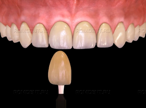 ROMDENT | Цены на отбеливание зубов: как сэкономить на процедуре?