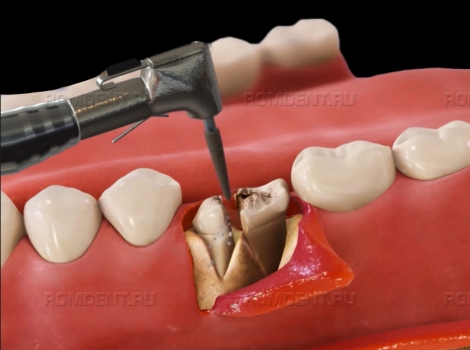 ROMDENT | Цены на удаление зубов и качество оказания медицинских услуг