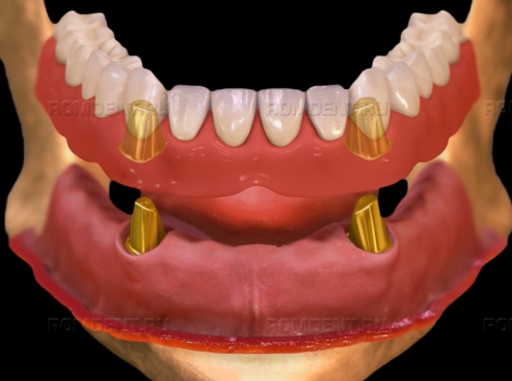 ROMDENT | Цены на установку зубных протезов