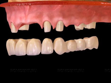 ROMDENT | Цены на вставку зубов: лучше или дешевле?