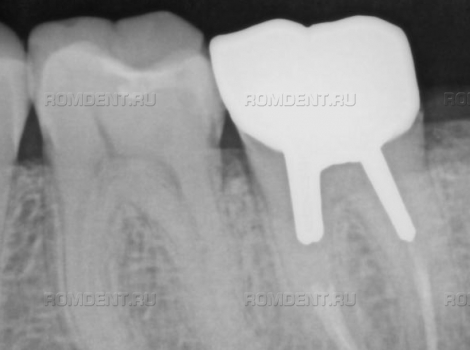 ROMDENT | Что делать, если болит зуб после установки коронки?