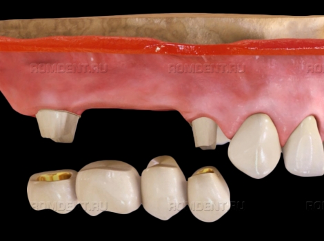 ROMDENT | Вставить 2 зуба