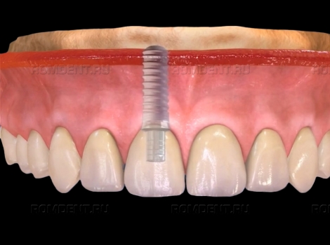 ROMDENT | Гарантия на импланты зубов