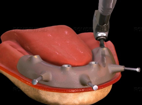 ROMDENT | Где делают имплантацию зубов?