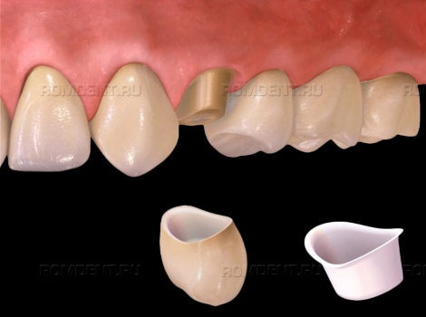 ROMDENT | Где поставить коронку на зуб: сравнение вариантов и цен