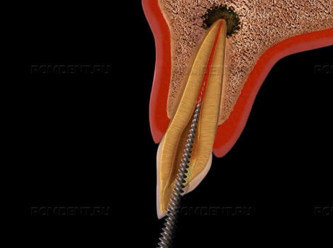 ROMDENT | Хронический периодонтит: лечение и его особенности