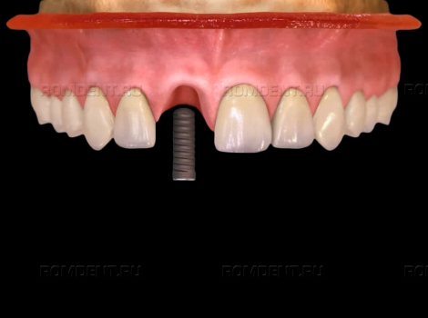 ROMDENT | Имплантация 1 зуба