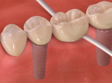 ROMDENT | Как правильно ухаживать за зубными имплантами после установки