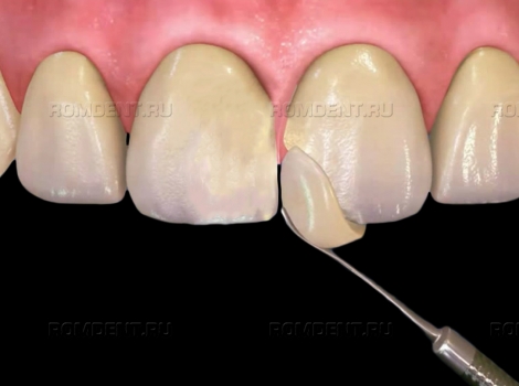 ROMDENT | Как выполняется реставрация зубов пломбой