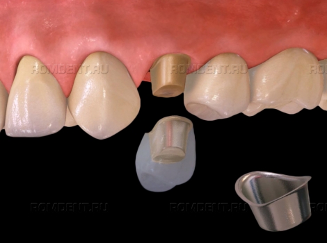 ROMDENT | Металлокерамическая коронка