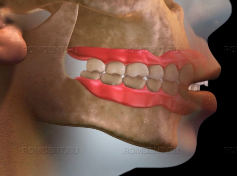ROMDENT | Методики и способы установки верхних и нижних зубных протезов