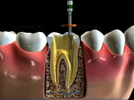 ROMDENT | Методы лечения периодонтита: от чего зависит выбор
