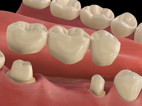 ROMDENT | Мостовидное протезирование зубов