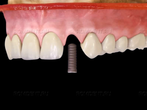ROMDENT | Можно ли поставить импланты после удаления зубов сразу?