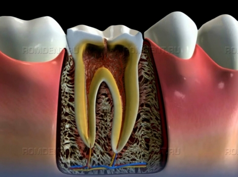 ROMDENT | Осложнения кариеса