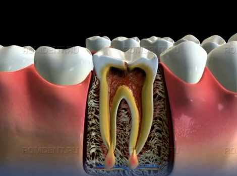 ROMDENT | Периодонтит корня зуба — лечение, методы, особенности