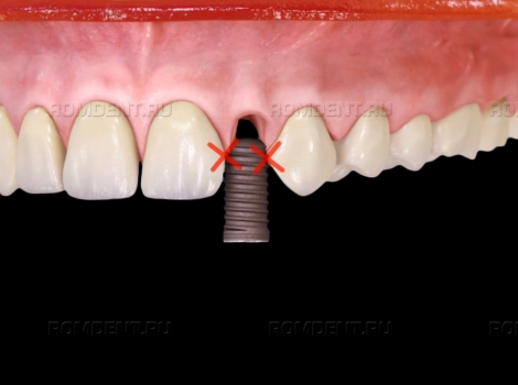 ROMDENT | Почему не стоит искать, где поставить импланты недорого, а обращаться к профессионалам
