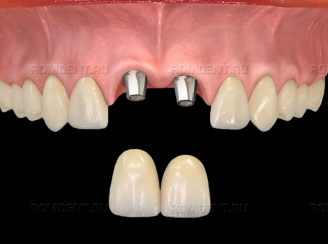 ROMDENT | Показания к имплантации зубов