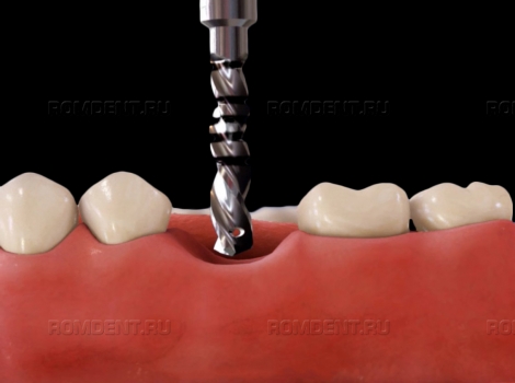 ROMDENT | Популярные вопросы по имплантам