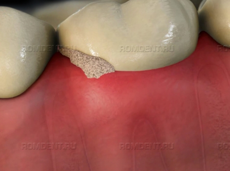 ROMDENT | Причины, лечение и последствия образования зубного камня