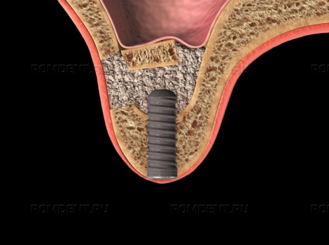 ROMDENT | Синус-лифтинг — наращивание костной ткани