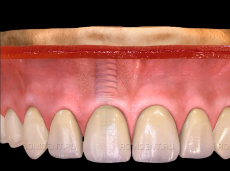 ROMDENT | Сколько стоит поставить имплант?