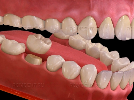 ROMDENT | Сколько стоит поставить коронку на зуб