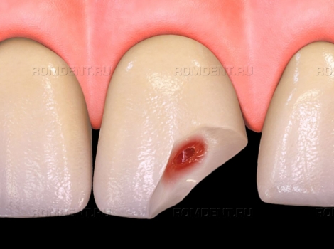 ROMDENT | Травмы зубов: способы лечения и восстановления