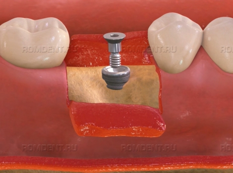 ROMDENT | Удаление импланта зуба
