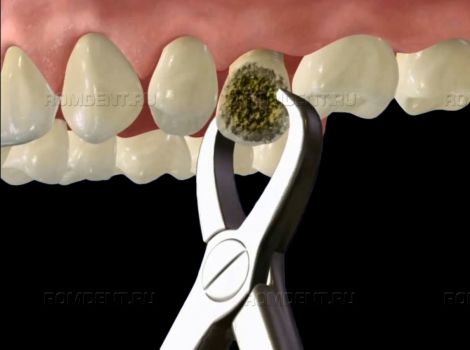 ROMDENT | Удаление корней зубов: показания и этапы